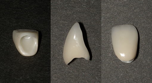 オールセラミック